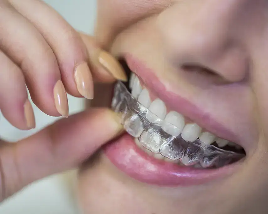 Invisalign — alinhadores transparentes